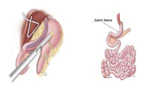 Pin On Weight Loss Surgery