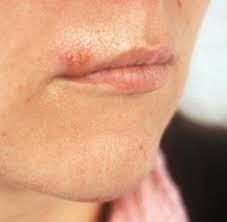 Streptokokken sind eine bakterienart, die oft harmlos sind, jedoch manchmal erkrankungen auslösen können. Herpes Der Unterschatzte Virus Welt