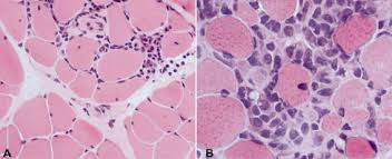 Image result for Polymyositis