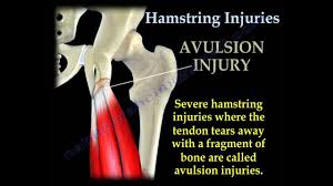 Rarely, surgery may be needed to repair a hamstring muscle or tendon. Hamstrings Physiopedia
