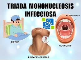 Mononucleosis infecciosa (enfermedad del beso): Chuletas Medicas Ø¯Ø± ØªÙˆÛŒÛŒØªØ± Que Signos Esperamos Encontrar En Una Mononucleosis Infecciosa Dralexvelasco Infecciosas Medicina