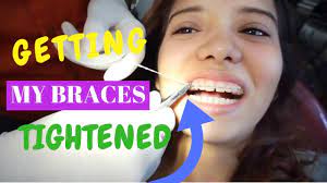 How often do you get your braces tightened. Getting Braces Tightened How I Fixed My Broken Wire Youtube