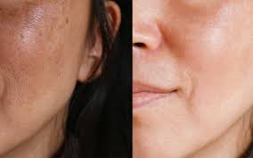 Numerous dermatological conditions represent imperfections that can dramatically lower the beauty of a person's face. What Causes Uneven Skin Texture Perfection Plastic Surgery Skin Care