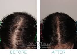 The types of treatments available to women will depend upon the type of hair loss they are experiencing. After 20 Years Of Thinning Hair One Woman Found Help In Wellesley