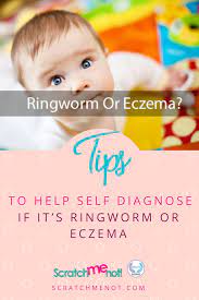 Is It Ringworm Or Eczema Sometimes It S Hard To Determine What Type Of Itchy Rash It Truly Is Fast Ringworm Rem Ringworm Remedies Nummular Eczema Eczema Kids