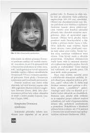 Downův syndrom je spojen s poruchou vývoje některých vnitřních orgánů (kardiovaskulárního systému), s neurologickým postižením (epileptické záchvaty) a s retardací intelektu a poruchami řeči. Downuv Syndrom Jeho Obraz Z Lekarskeho Hlediska Pdf Stazeni Zdarma