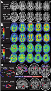 Questionable efficacy, a high cost of usd 50. Symptomatic Amyloid Related Imaging Abnormalities In An Apoe E4 E4 Patient Treated With Aducanumab Vandevrede 2020 Alzheimer S Amp Dementia Diagnosis Assessment Amp Disease Monitoring Wiley Online Library