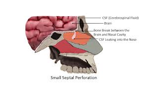 As the hardest part of the nasal cavity, the nasal bones protect these arteries and nerves from damage. Nasal Septal Perforation Repair Dr Mourad Head And Neck Surgeon