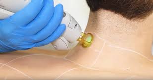 The most obvious advantage is that you will no longer have to deal with daily shaving or maintenance. Why Are More Men Getting Laser Hair Removal Men S Style Blog