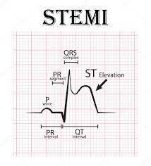 ECG de infarto de miocardio con elevación del ST (IAMCEST) y detalle del ECG  (onda P,