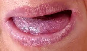 Clinically proven results · reverses early gum damage Small Bumps On Tongue Could Be New Coronavirus Symptom To Look Out For Docs Warn