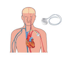 Image result for Internal Cardiac Defibrillator