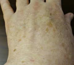 Hi, i've had a freckle on the palm of my hand for as long as i can remember. Liver Spot Wikipedia