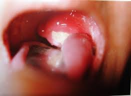 Image result for Tonsillolith