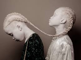 L'albinisme : un exemple de la "double peine" des maladies ...