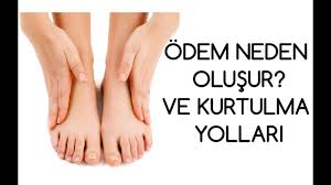 Odem Neden Olusur Ve Kurtulma Yollari Youtube