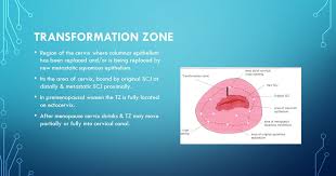 The cancer might invade other tissues and organs. Cervical Cancer Signs And Symptoms Broksityblog