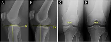 Anterior cruciate ligament (acl) injuries——functional acl knee brace. Treatment After Acl Injury Panther Symposium Acl Treatment Consensus Group British Journal Of Sports Medicine
