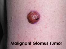Image result for Glomus tumor