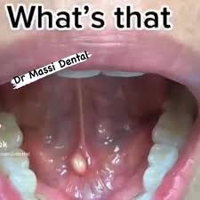 Image result for Sialolithiasis