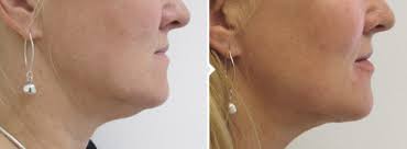 Les mckeown suddenly died on tuesday morning aged 65 (image: Neck Liposuction Chin Liposuction Glasgow Dr Darren Mckeown
