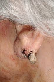 Image result for cornu cutaneum)