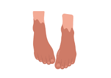 Image result for treatment of pad of foot which is red, purple