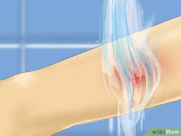 Again, considering a graze wound is mostly a skin injury then applying pressure should be enough to stop the bleeding. How To Treat A Graze 14 Steps With Pictures Wikihow