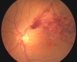 Gefaessverschluesse Im Auge Auge Online