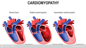 Hypertrophic Cardiomyopathy Texas Heart Institute