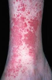 Image result for Vasculitis