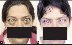 Patient After Thyroidectomy With Exophthalmos Of 32 Mm And With Eyelid Download Scientific Diagram