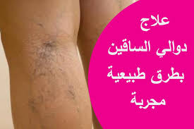 علاج دوالي الساقين بطرق طبيعية مجربة Youtube