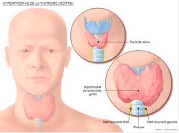 Les kystes fonctionnels et complexes peuvent finir par éclater. Thyroide Goitre Hetero Multinodulaire Cancerologie Chirurgie Viscerale Et Digestive Chirurgie Du Beaujolais