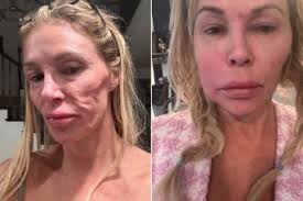 Brandi Glanville 'Sick of the Way I Look' amid Facial Parasite Crisis