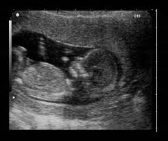 6 Ways To Tell Baby S Gender From An Early Sonogram Baby Gender Ultrasound Baby Gender Early Gender Ultrasound