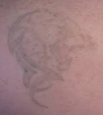Fortunately, laser technology provides an opportunity to remove unwanted tattoos. Laser Tattoo Removal Archives Smith Stephen Smithfacialplastics Com