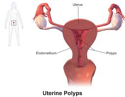 Differences in characteristics of 1. Uterine Fibroid Ù…Ø¹Ù†Ø§Ù‡Ø§ Ø¨Ø§Ù„Ø¹Ø±Ø¨ÙŠ