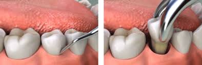 Don't keep twisting or a baby tooth that stays a little loose but doesn't get looser or come out for 6 months or longer. Dental Extractions Belhaven Dental Surgery