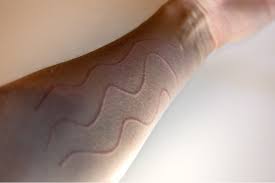 Image result for Dermatographism