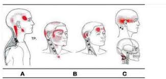 Dolore Cervicale Che Non Passa Perche Ryakos Center