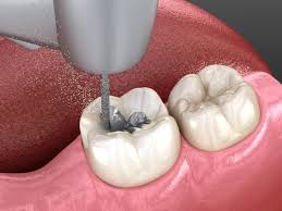 Check spelling or type a new query. Zahnerhaltung Spezialisten Bei Smile Health In Leipzig