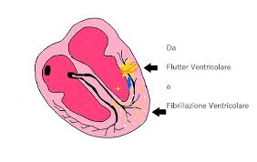 La fibrillazione ventricolare è una forma grave di aritmia cardiaca, una sequenza scoordinata di rapide contrazioni ventricolari causata da impulsi elettrici. Le Principali Aritmie Cardiache Al Tracciato Ecg Spiegate In Modo Semplice