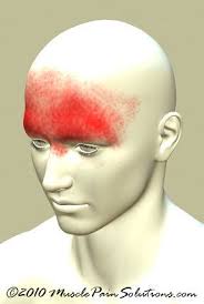 Frontal Headaches Frontal Headache Sinus Headache Chronic Sinus Headache