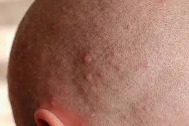 Image result for sores on the head in children