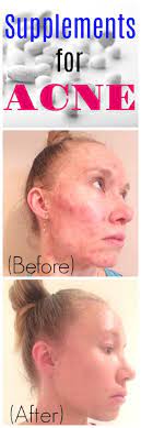 Vitamin a comes in both pill and liquid form. Supplements For Acne Natural Acne Remedies Pure And Simple Nourishment