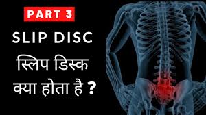 We would like to show you a description here but the site won't allow us. Slipped Disc In Lower Back Part 3 6 à¤¸ à¤² à¤ª à¤¡ à¤¸ à¤• à¤• à¤¯ à¤¹ à¤¤ à¤¹ Youtube