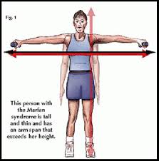 Marfan Syndrome Physiopedia