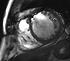 Image result for Left Ventricular Noncompaction