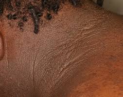 Image result for Thesium nigricans